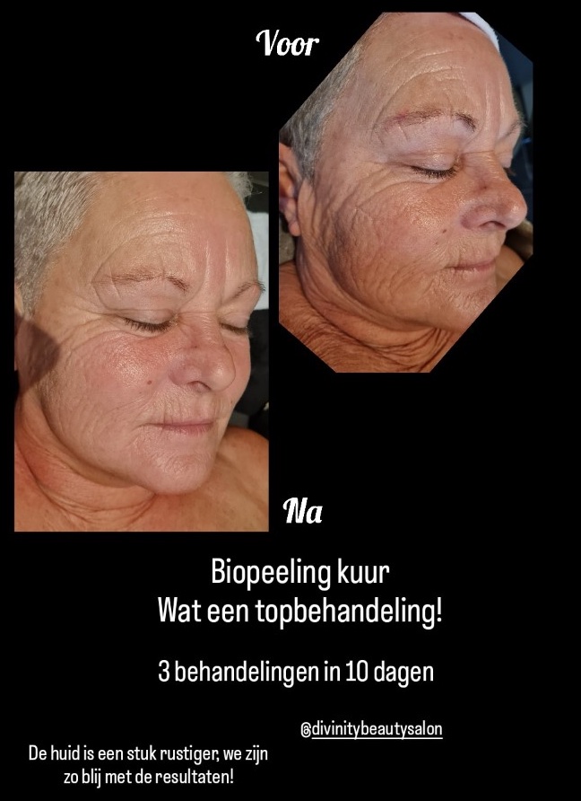 BIOPEELING